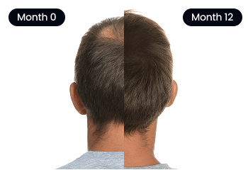 topical minoxidil
